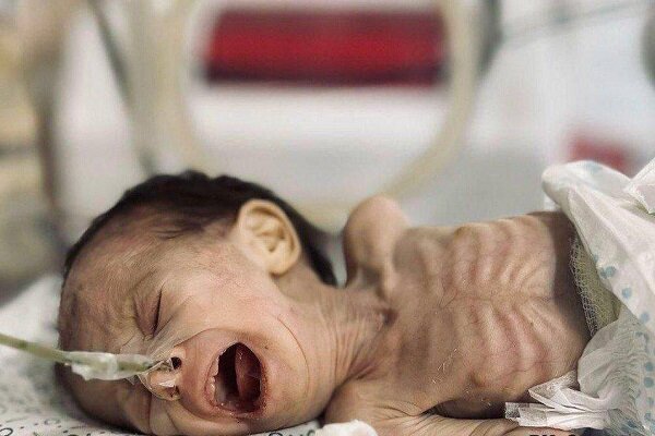 מות קדושים של ילד פלסטיני נוסף בעזה עקב רעב